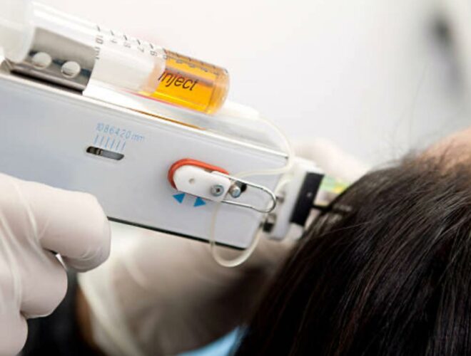Mesotherapy for Hair Loss