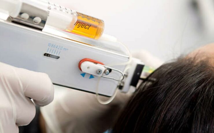 Mesotherapy for Hair Loss
